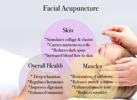 A diagram of facial acupuncture and the benefits.